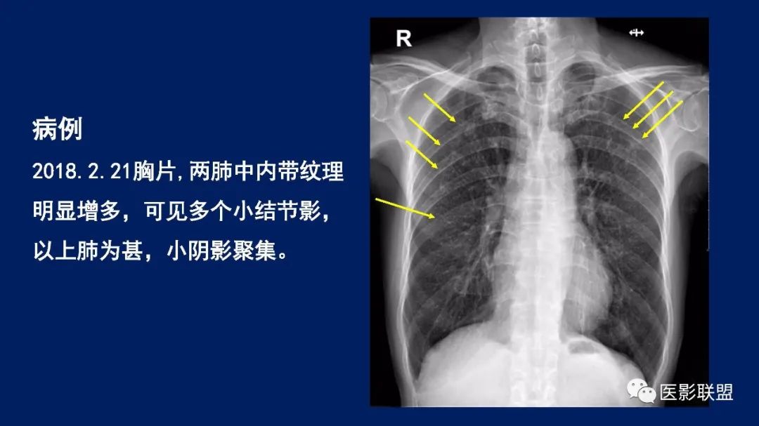 影像PPT - 【PPT】如何精准解读尘肺X片及诊断-3