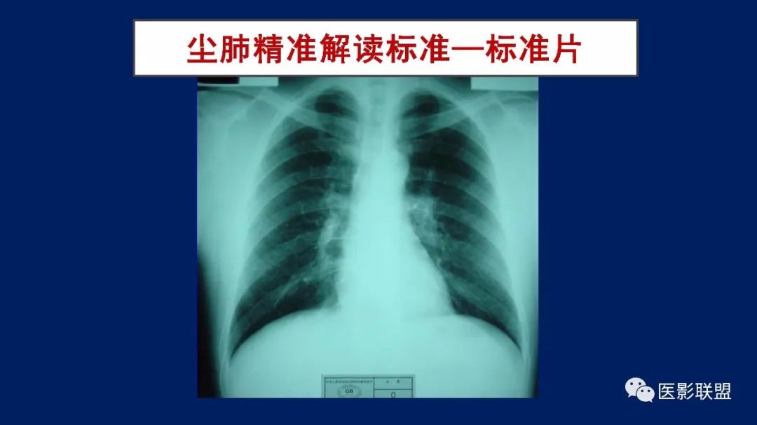 影像PPT - 【PPT】如何精准解读尘肺X片及诊断-17