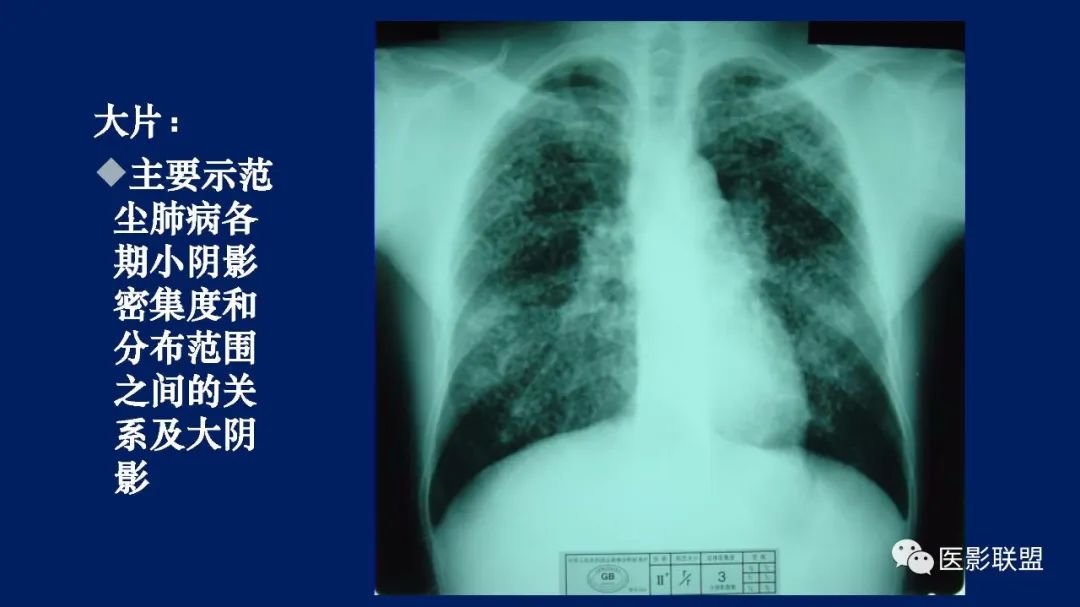 影像PPT - 【PPT】如何精准解读尘肺X片及诊断-22