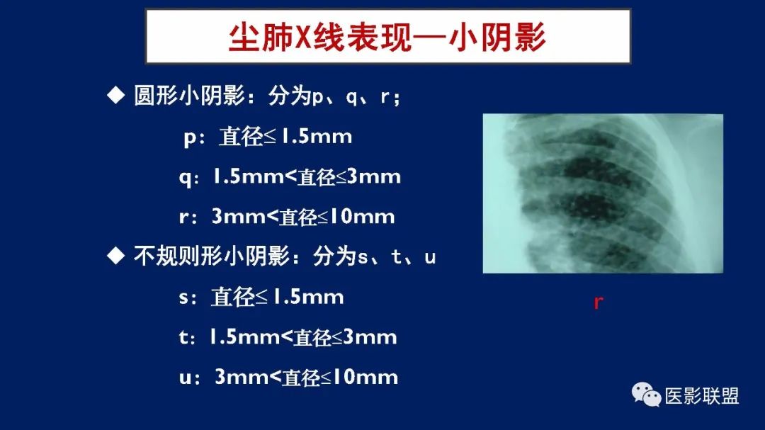 影像PPT - 【PPT】如何精准解读尘肺X片及诊断-24