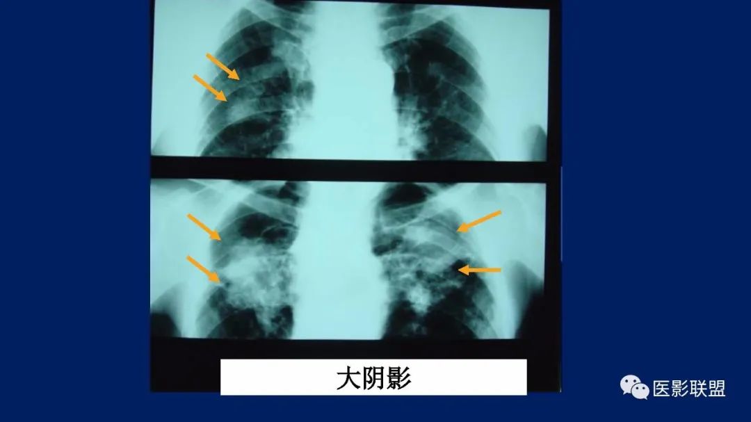 影像PPT - 【PPT】如何精准解读尘肺X片及诊断-31
