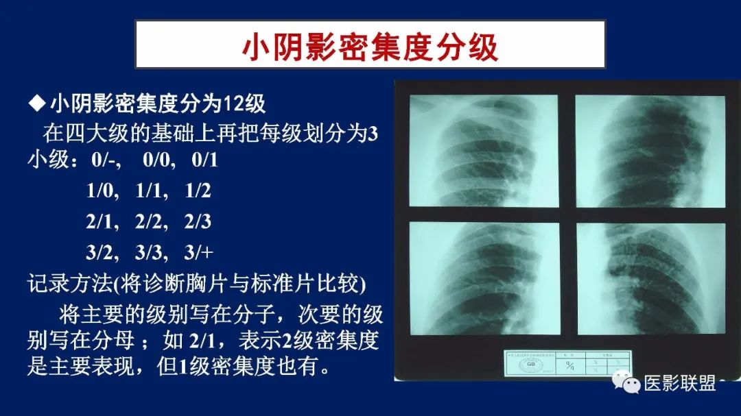影像PPT - 【PPT】如何精准解读尘肺X片及诊断-36