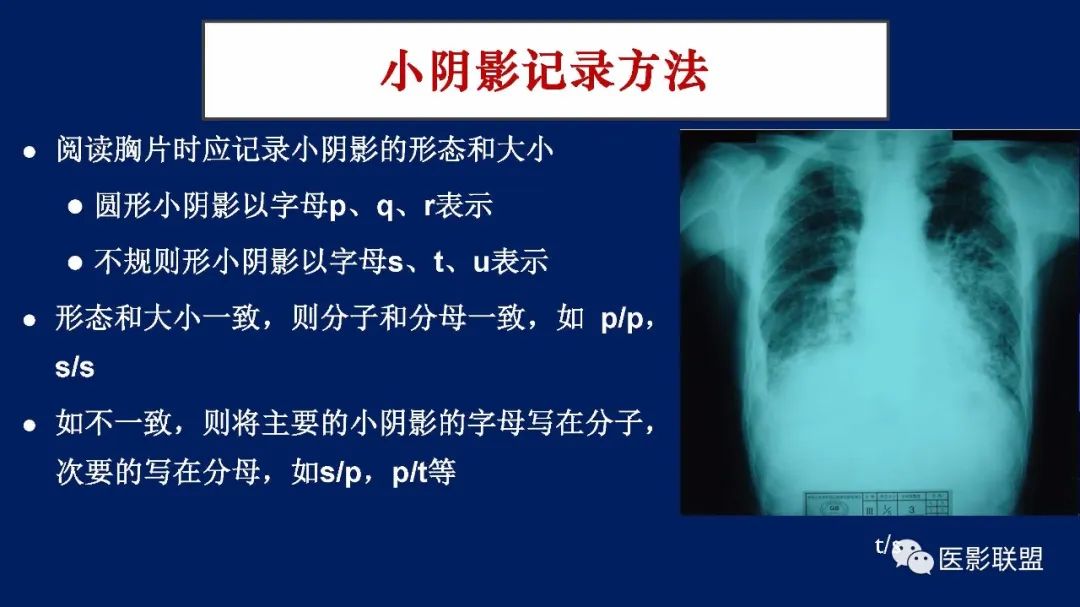 影像PPT - 【PPT】如何精准解读尘肺X片及诊断-47