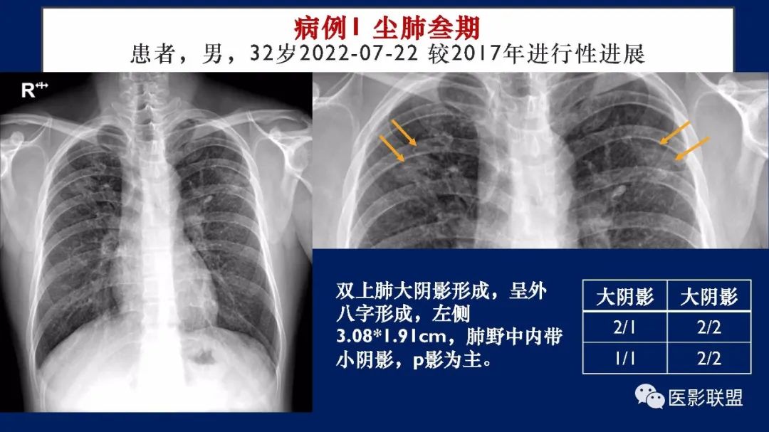 影像PPT - 【PPT】如何精准解读尘肺X片及诊断-64