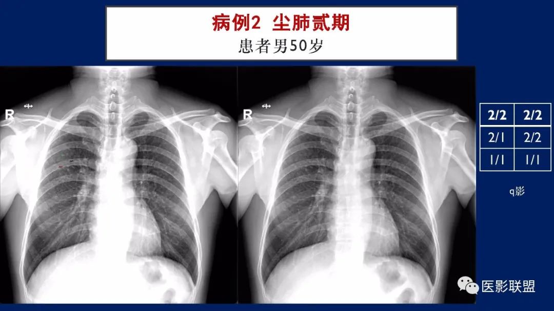 影像PPT - 【PPT】如何精准解读尘肺X片及诊断-65