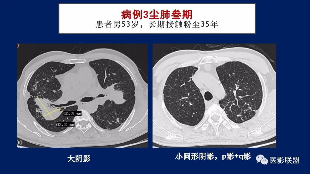 影像PPT - 【PPT】如何精准解读尘肺X片及诊断-67