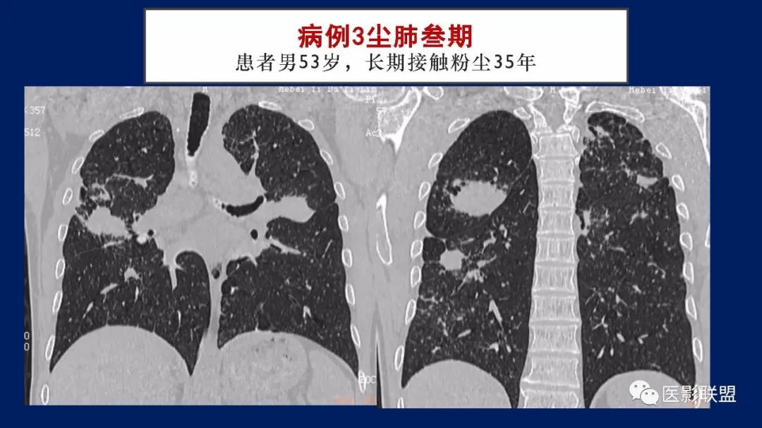 影像PPT - 【PPT】如何精准解读尘肺X片及诊断-66