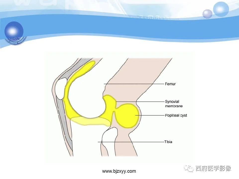 影像PPT - 【PPT】膝关节囊性病变影像诊断-6