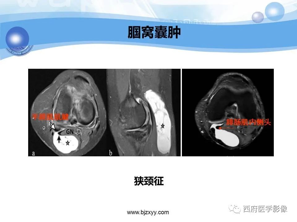 影像PPT - 【PPT】膝关节囊性病变影像诊断-8