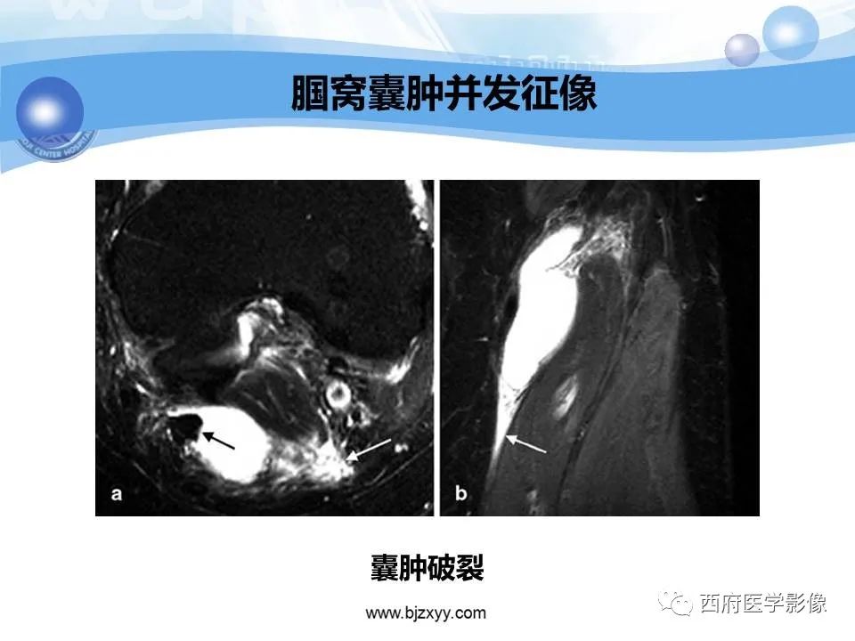 影像PPT - 【PPT】膝关节囊性病变影像诊断-9