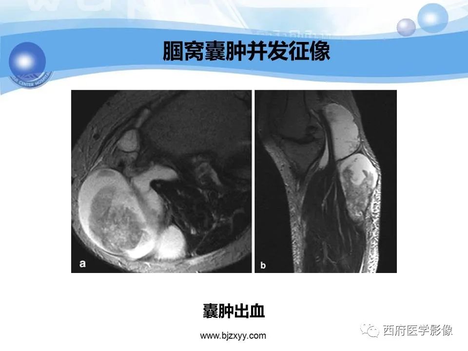 影像PPT - 【PPT】膝关节囊性病变影像诊断-10