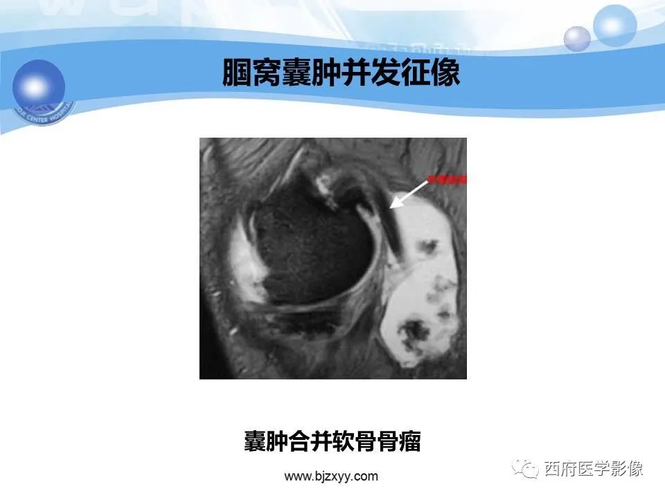 影像PPT - 【PPT】膝关节囊性病变影像诊断-11