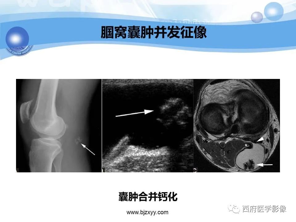 影像PPT - 【PPT】膝关节囊性病变影像诊断-12