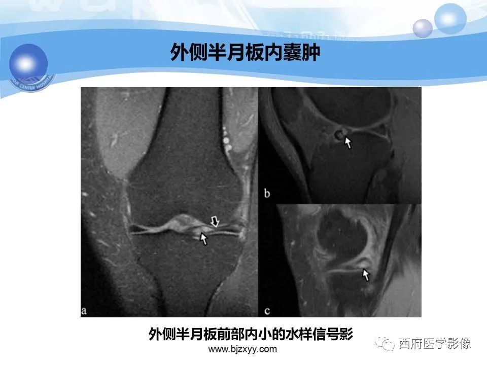 影像PPT - 【PPT】膝关节囊性病变影像诊断-15
