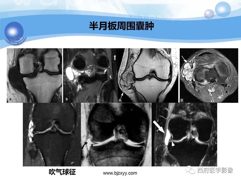 影像PPT - 【PPT】膝关节囊性病变影像诊断-16