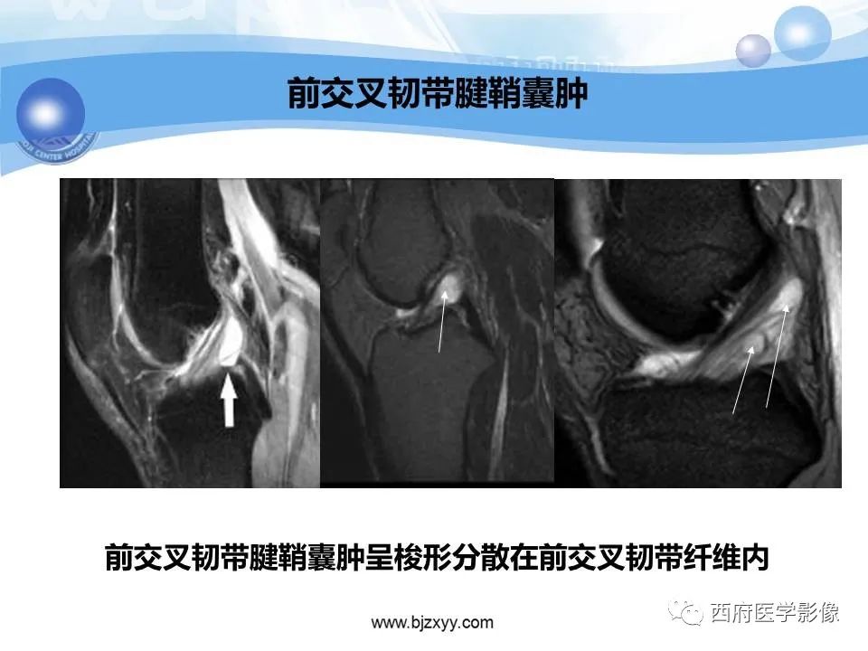 影像PPT - 【PPT】膝关节囊性病变影像诊断-18