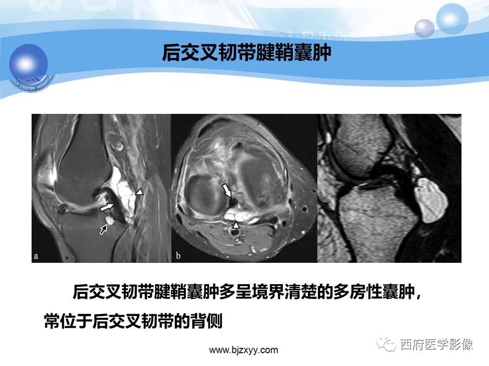 影像PPT - 【PPT】膝关节囊性病变影像诊断-19