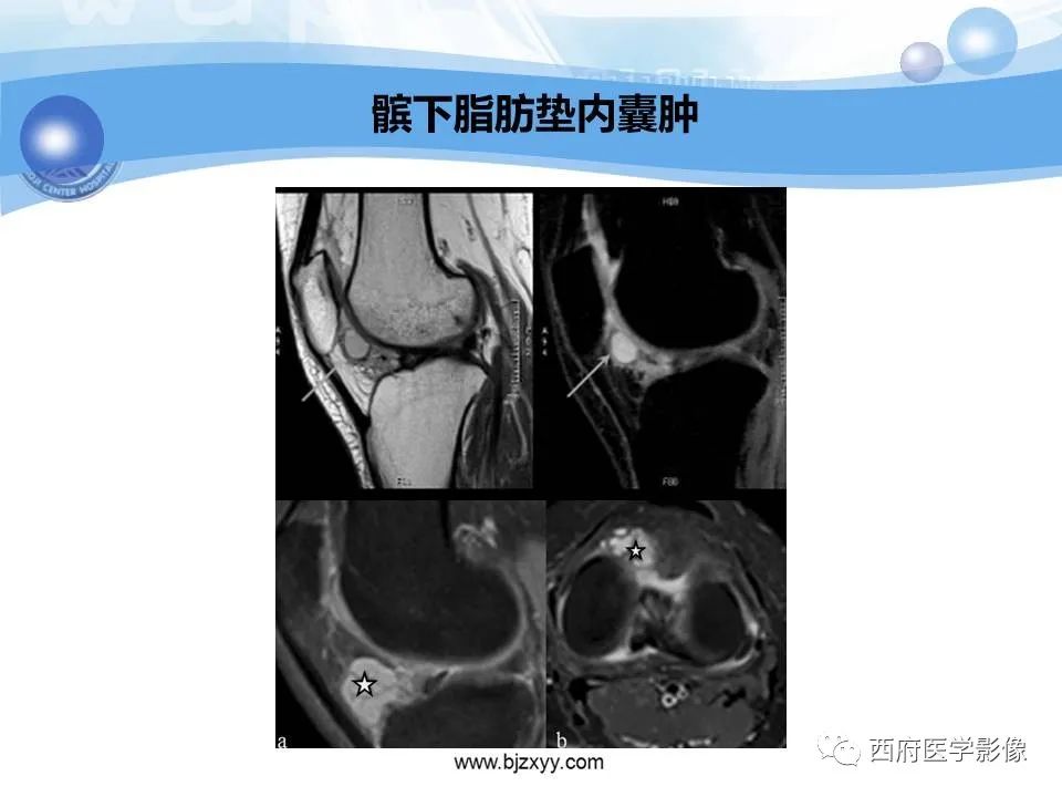 影像PPT - 【PPT】膝关节囊性病变影像诊断-21