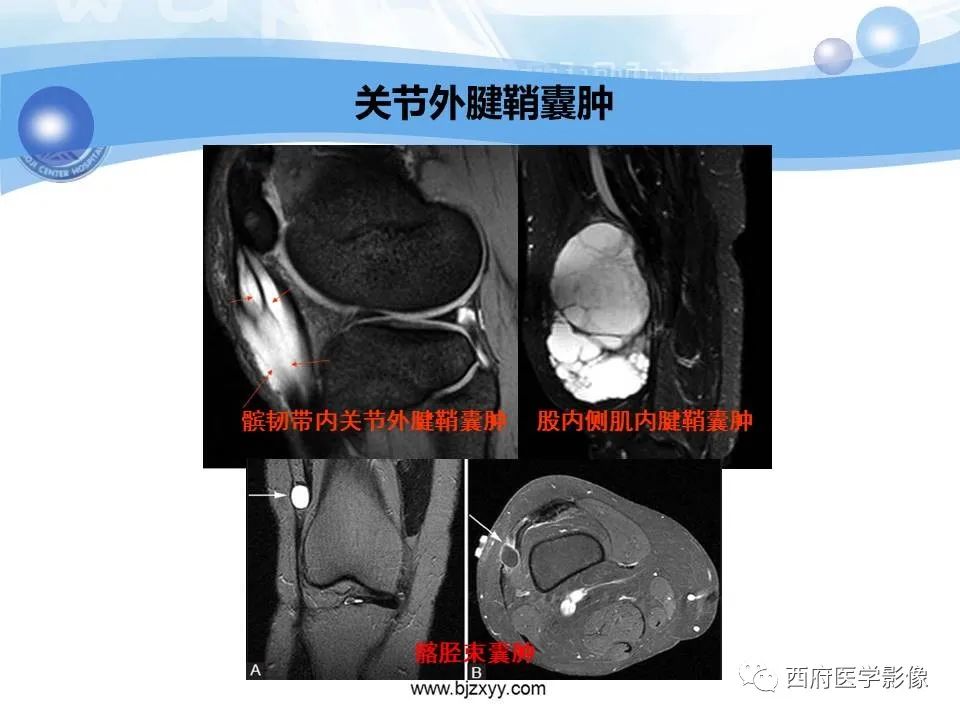 影像PPT - 【PPT】膝关节囊性病变影像诊断-23