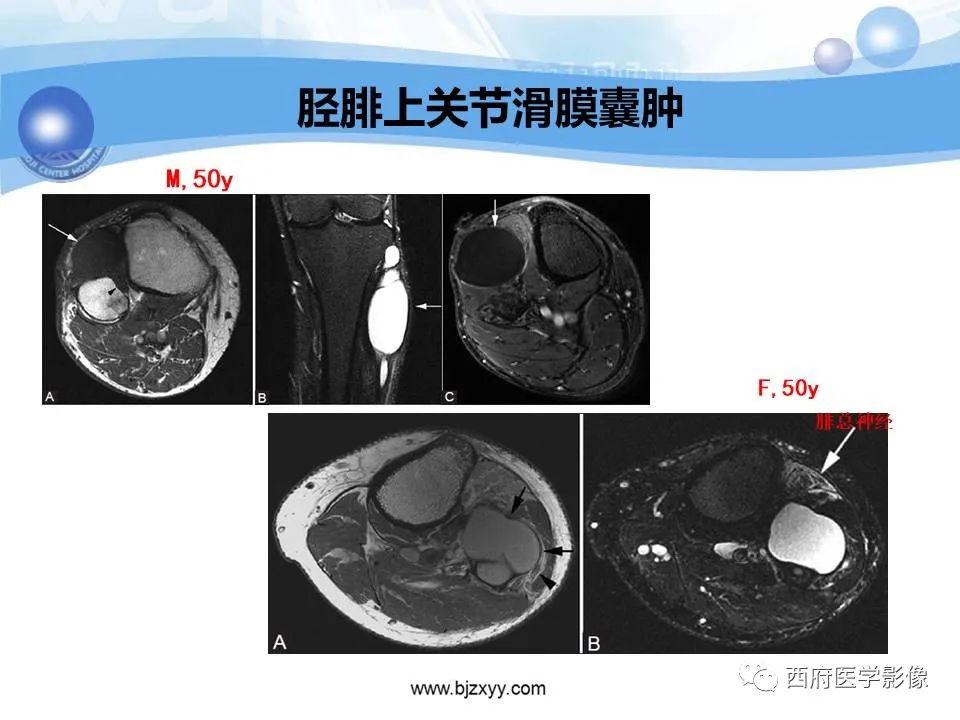 影像PPT - 【PPT】膝关节囊性病变影像诊断-24