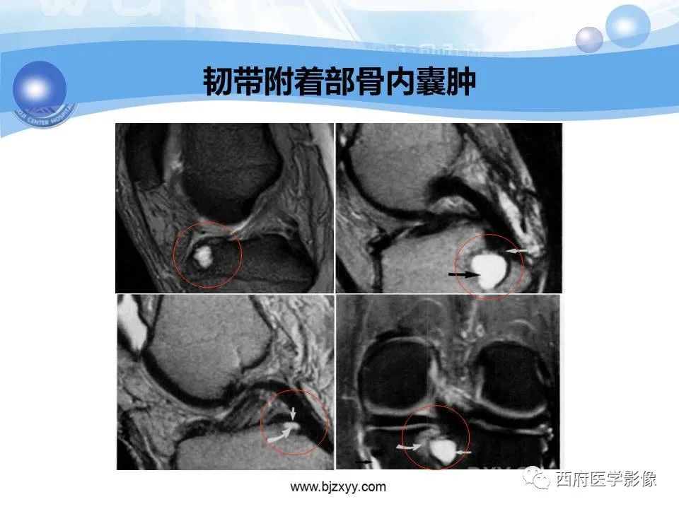 影像PPT - 【PPT】膝关节囊性病变影像诊断-26