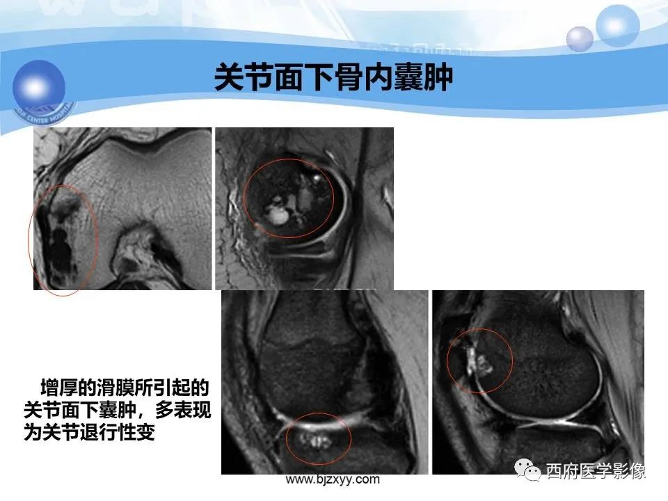 影像PPT - 【PPT】膝关节囊性病变影像诊断-27