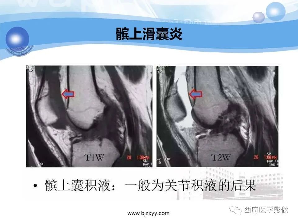 影像PPT - 【PPT】膝关节囊性病变影像诊断-30