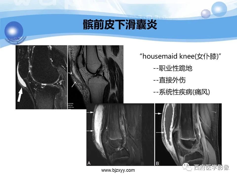 影像PPT - 【PPT】膝关节囊性病变影像诊断-31