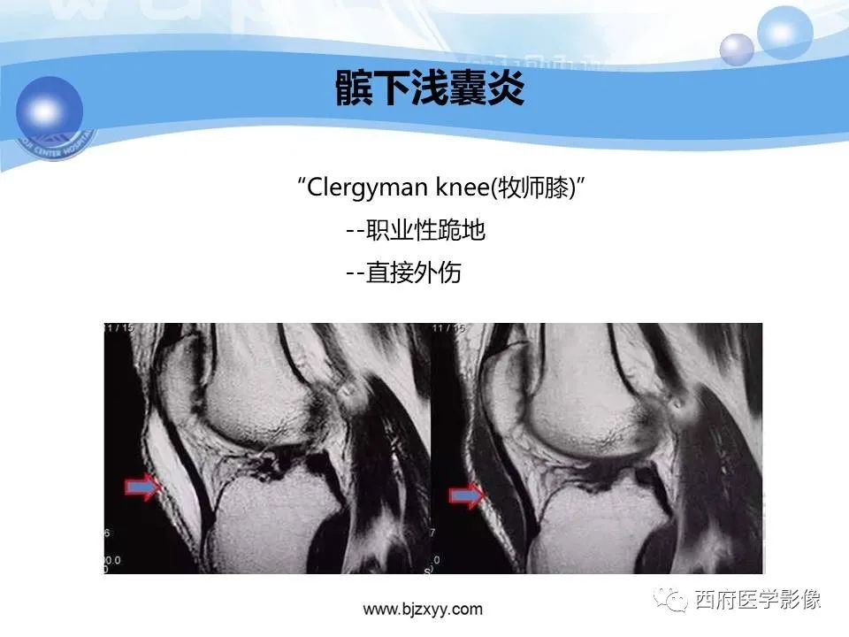 影像PPT - 【PPT】膝关节囊性病变影像诊断-32