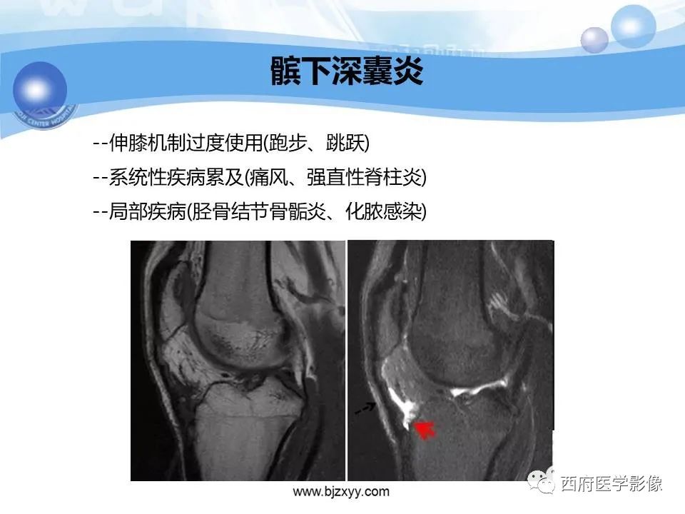 影像PPT - 【PPT】膝关节囊性病变影像诊断-33