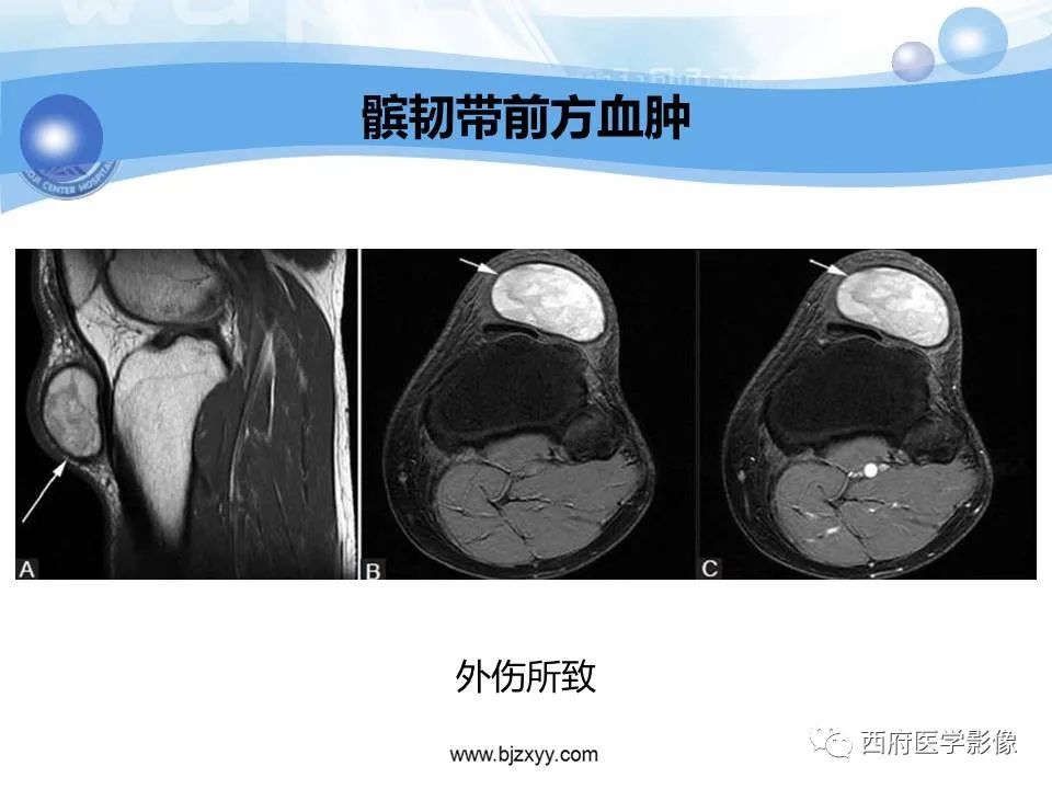 影像PPT - 【PPT】膝关节囊性病变影像诊断-35