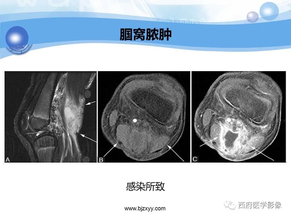 影像PPT - 【PPT】膝关节囊性病变影像诊断-36