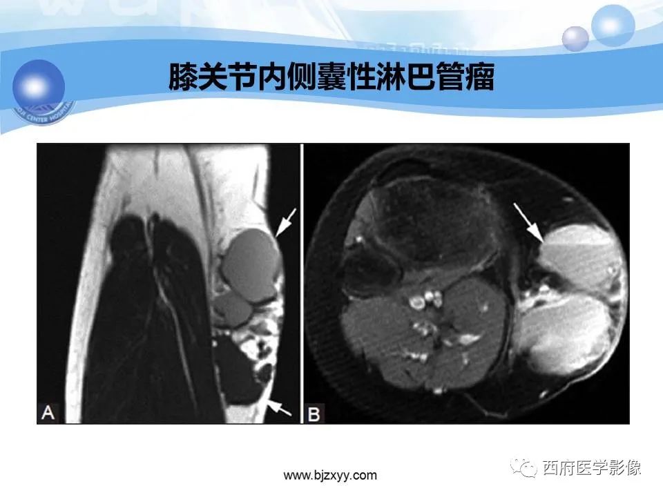 影像PPT - 【PPT】膝关节囊性病变影像诊断-40