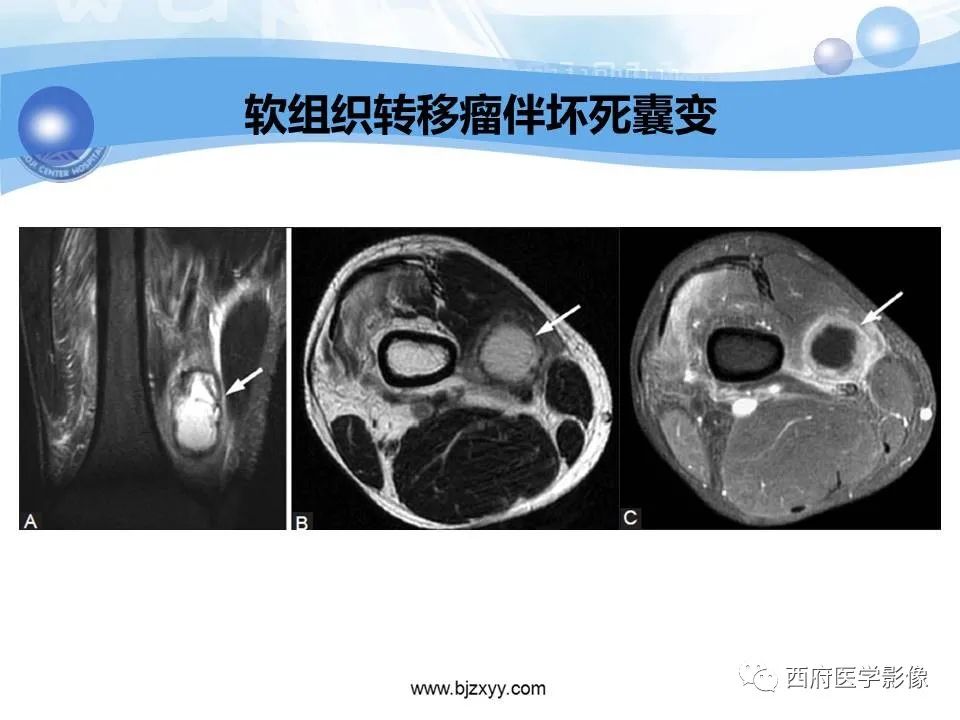 影像PPT - 【PPT】膝关节囊性病变影像诊断-42