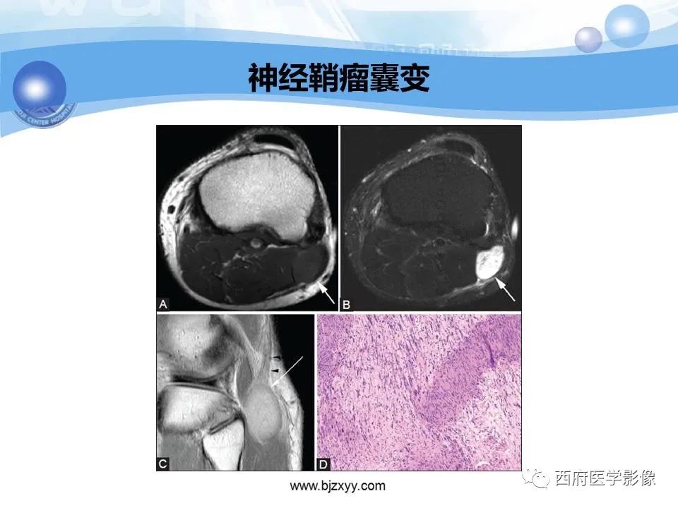 影像PPT - 【PPT】膝关节囊性病变影像诊断-43