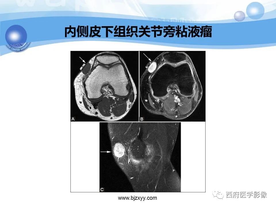 影像PPT - 【PPT】膝关节囊性病变影像诊断-45