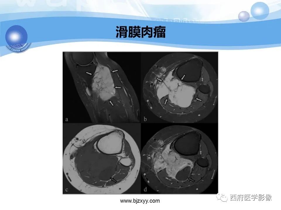 影像PPT - 【PPT】膝关节囊性病变影像诊断-46