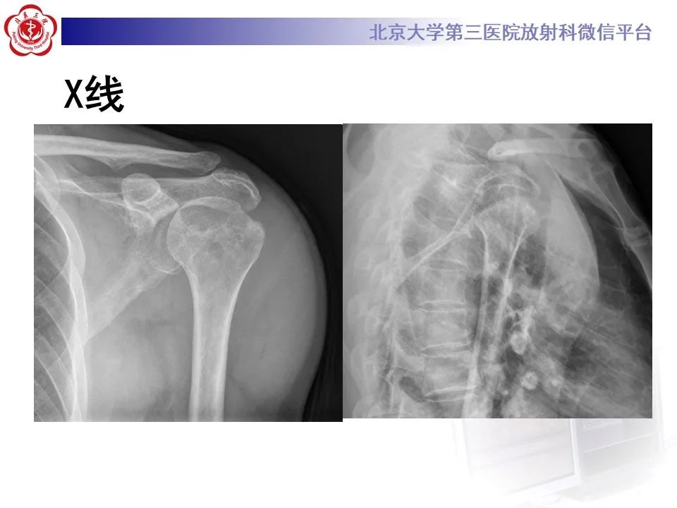 影像PPT - 【PPT】滑膜软骨瘤病-3