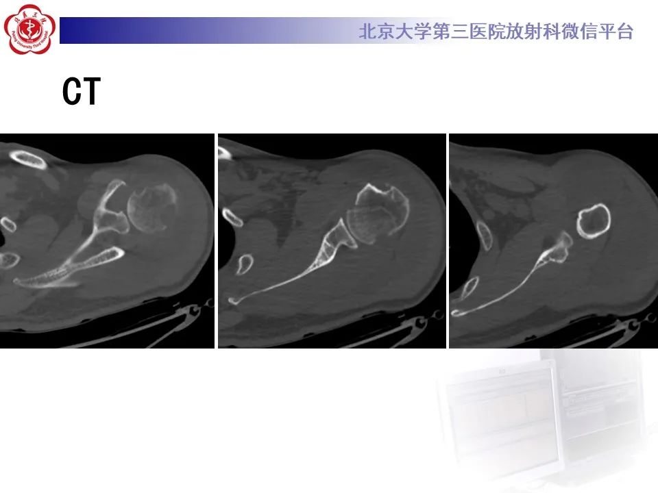 影像PPT - 【PPT】滑膜软骨瘤病-4