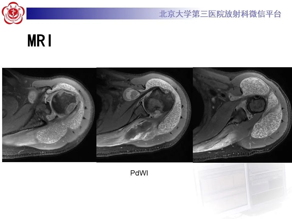 影像PPT - 【PPT】滑膜软骨瘤病-5