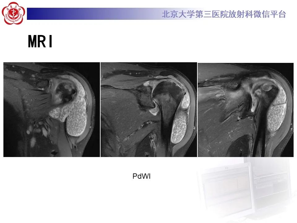 影像PPT - 【PPT】滑膜软骨瘤病-6