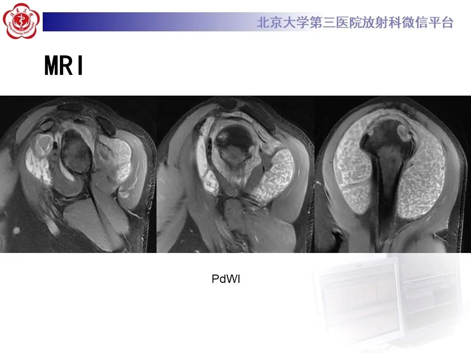 影像PPT - 【PPT】滑膜软骨瘤病-7