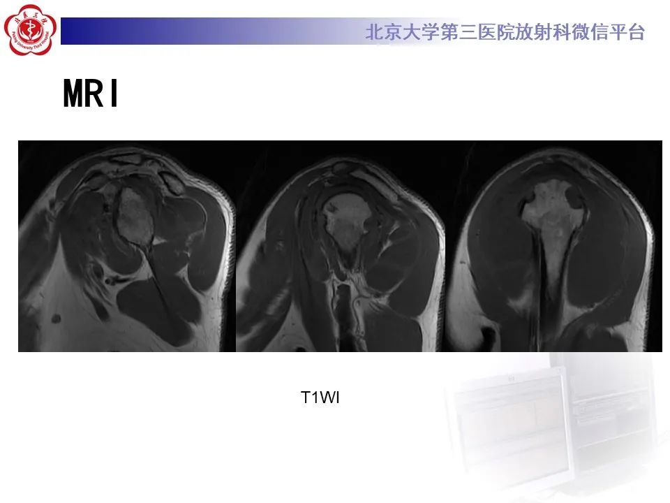 影像PPT - 【PPT】滑膜软骨瘤病-8