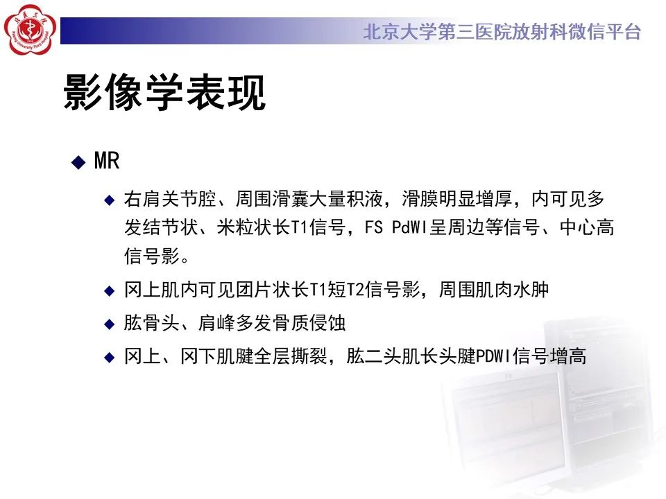影像PPT - 【PPT】滑膜软骨瘤病-10