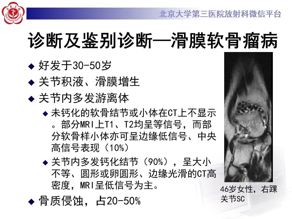 影像PPT - 【PPT】滑膜软骨瘤病-12