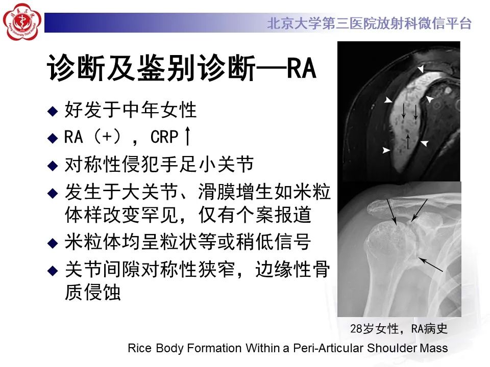 影像PPT - 【PPT】滑膜软骨瘤病-13