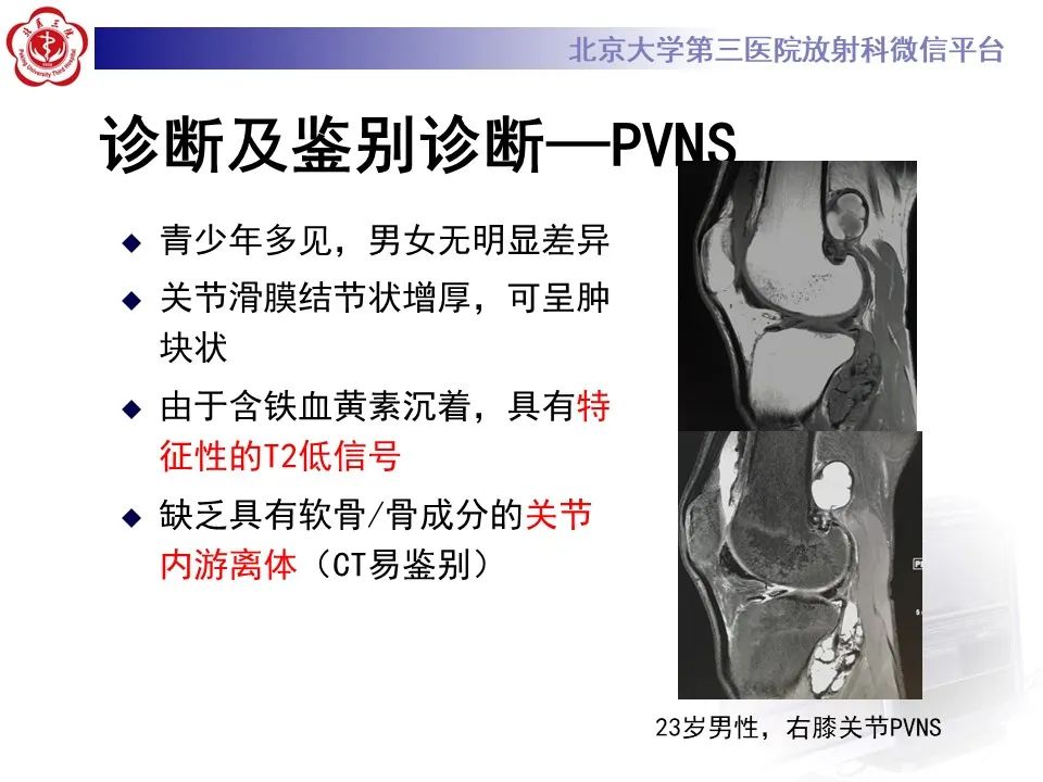 影像PPT - 【PPT】滑膜软骨瘤病-15