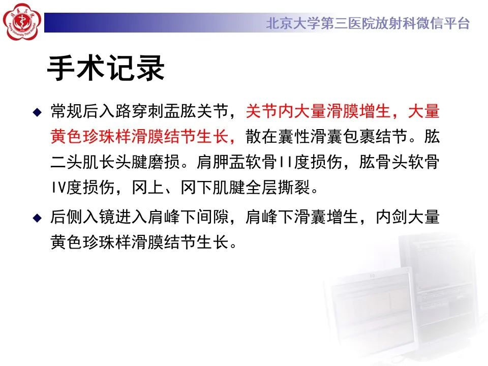 影像PPT - 【PPT】滑膜软骨瘤病-16