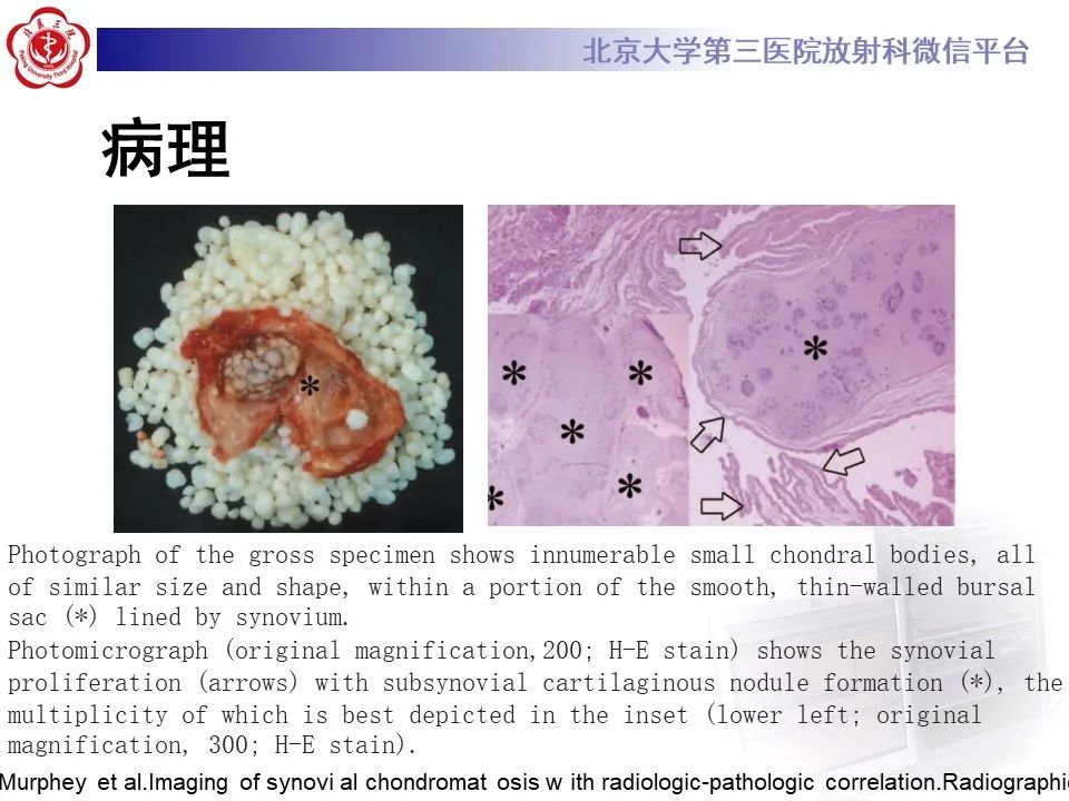 影像PPT - 【PPT】滑膜软骨瘤病-26