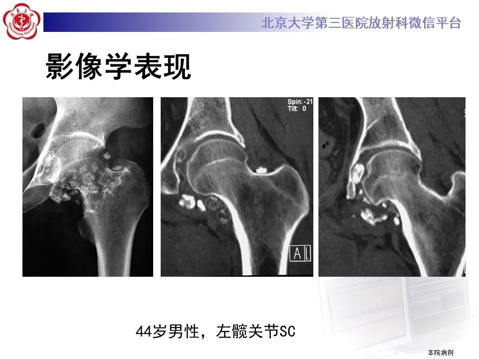 影像PPT - 【PPT】滑膜软骨瘤病-33